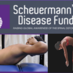 Scheuermannova choroba páteře